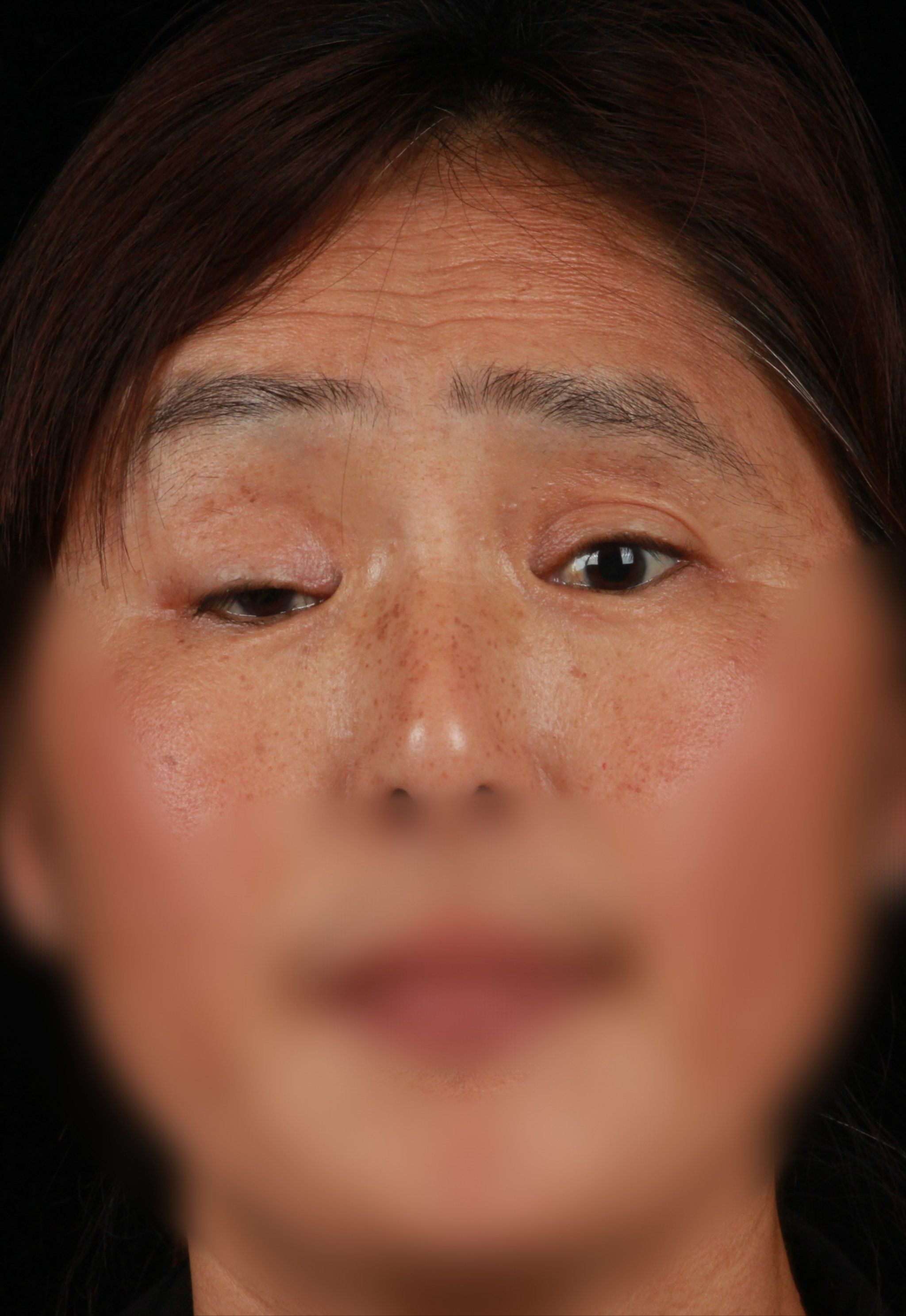 单侧重度上睑下垂矫正