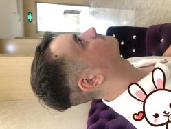 点击看大图 -大麦微针植发丨全国连锁