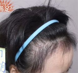 -大麦微针植发全国连锁