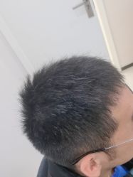 体验后-雍禾植发全国连锁