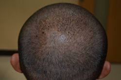 -大麦微针植发丨全国连锁