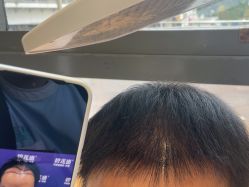 -碧莲盛·不剃发植发