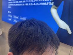 -碧莲盛·不剃发植发