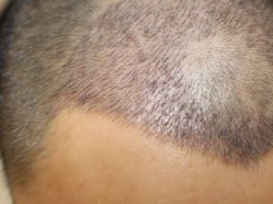 -大麦微针植发全国连锁