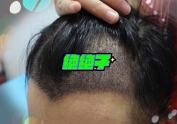 -大麦微针植发全国连锁