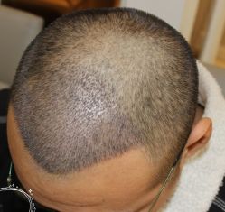 -大麦微针植发丨全国连锁