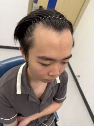 -大麦微针植发全国连锁