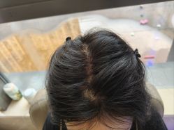 -碧莲盛·不剃发植发