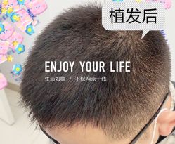 -大麦微针植发全国连锁