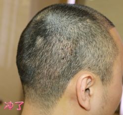 -大麦微针植发丨全国连锁