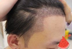 -大麦微针植发丨全国连锁