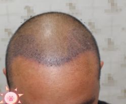 -大麦微针植发丨全国连锁