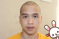 -大麦微针植发丨全国连锁