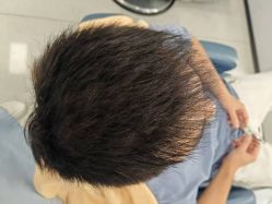 -大麦微针植发丨全国连锁