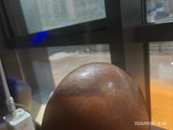 -碧莲盛·不剃发植发