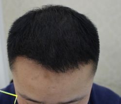 -大麦微针植发丨全国连锁