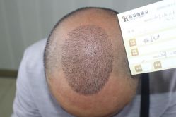 -大麦微针植发丨全国连锁