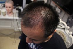 点击看大图 -大麦微针植发丨全国连锁