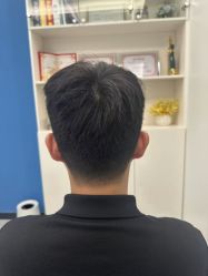 -大麦微针植发全国连锁