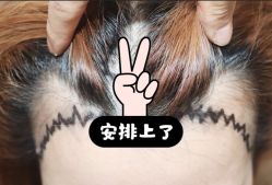 -大麦微针植发全国连锁