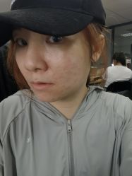 点击看大图 体验后-伊丽莎白医疗美容