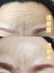 -More摩尔医美の注射线雕光电中心