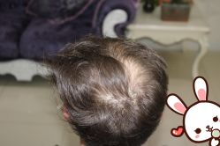 点击看大图 -大麦微针植发丨全国连锁