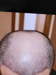 体验前-大麦微针植发全国连锁