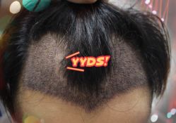 -大麦微针植发全国连锁