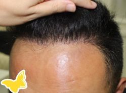 -大麦微针植发丨全国连锁