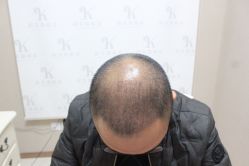 点击看大图 -大麦微针植发丨全国连锁