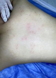 -爱莎扁平疣·汗管瘤·斑痣中心