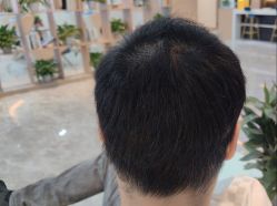 -碧莲盛·不剃发植发