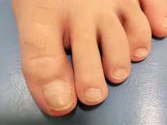 -世龙世家灰指甲鸡眼脚气甲沟炎跖疣护理(通州店)