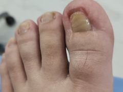 -Andrew指甲专科灰指甲·甲沟炎矫正·3D步态矫形鞋垫定制(浦三路店)