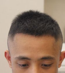 -大麦微针植发全国连锁