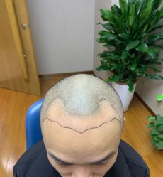 -大麦微针植发全国连锁