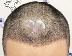 -大麦微针植发全国连锁