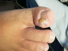 -世龙世家灰指甲鸡眼脚气甲沟炎跖疣护理(通州店)