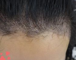 -大麦微针植发丨全国连锁