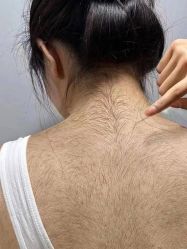 -薇兰专业脱毛连锁机构