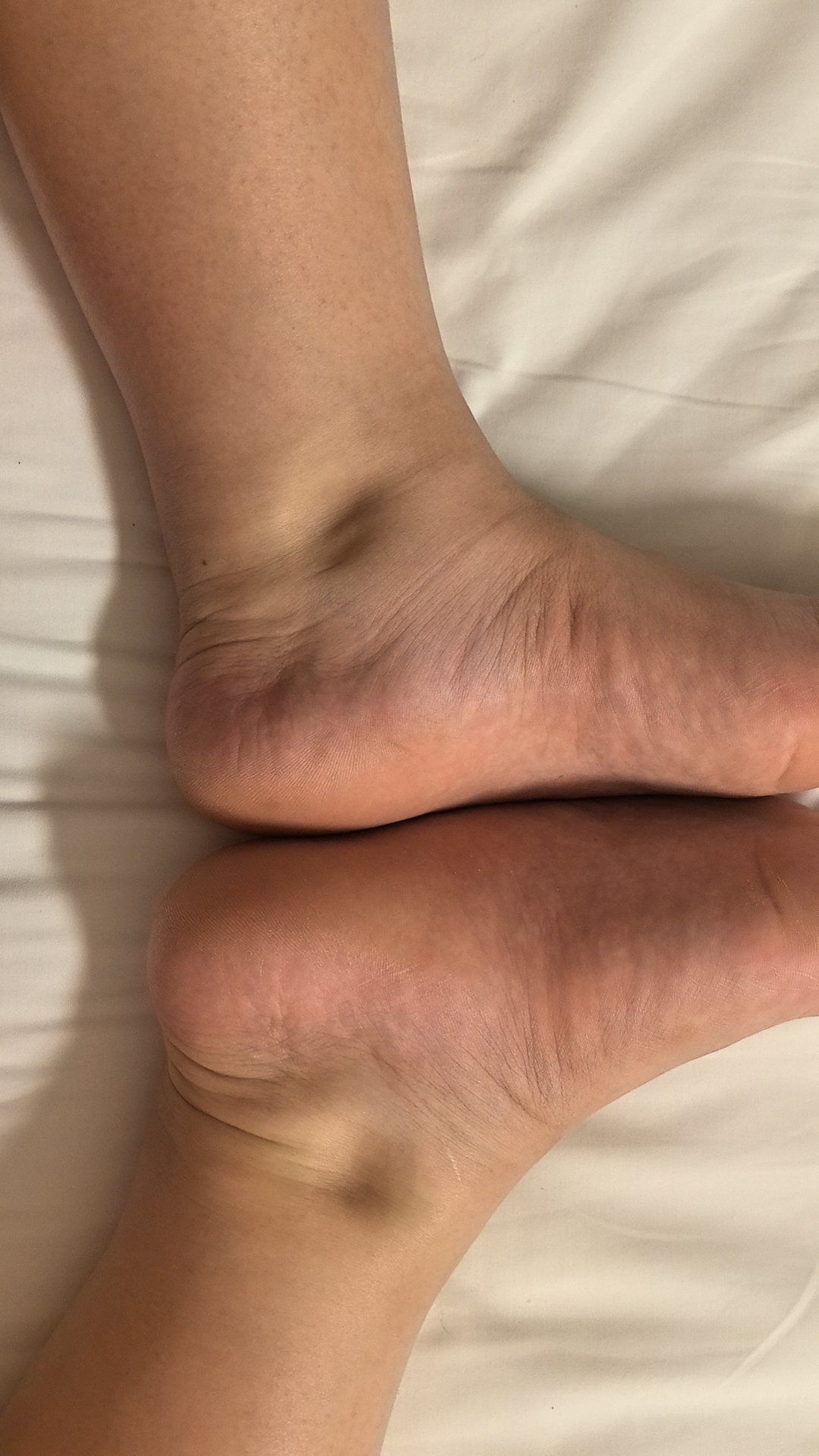 孕期水肿[流泪]