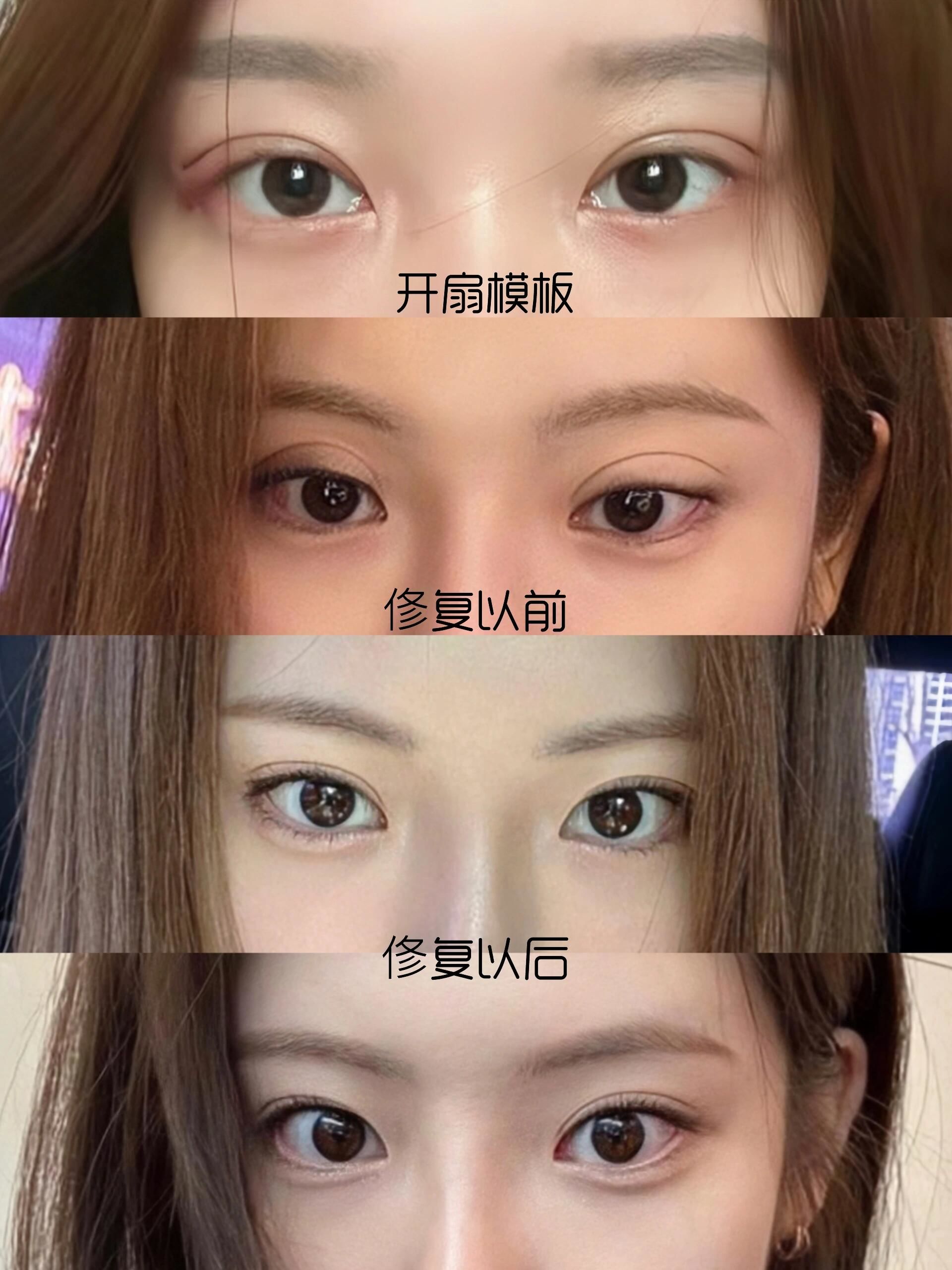 平扇和开扇 #双眼皮#全网都在晒双眼皮#医美涨姿势#我的医美体验分享