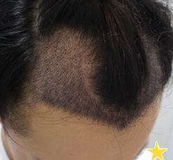 -大麦微针植发丨全国连锁