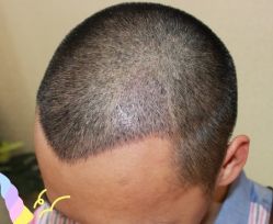 -大麦微针植发丨全国连锁