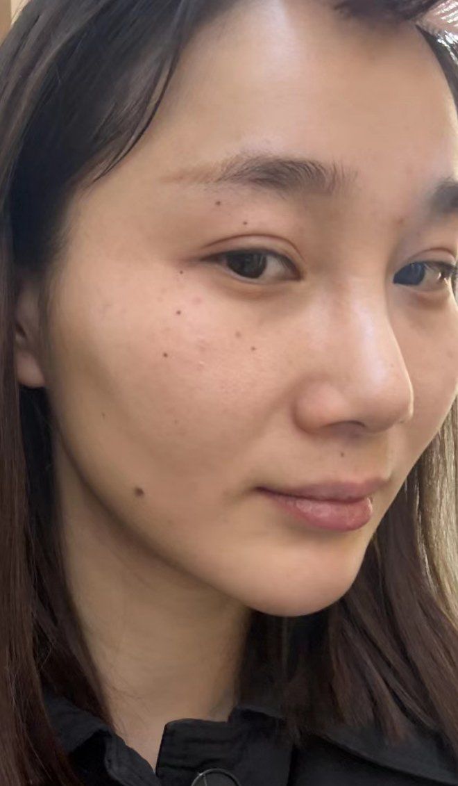 面颊凹陷能填玻尿酸吗❓