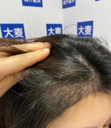 -大麦微针植发丨全国连锁