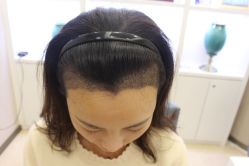 -大麦微针植发丨全国连锁