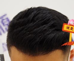 -大麦微针植发全国连锁