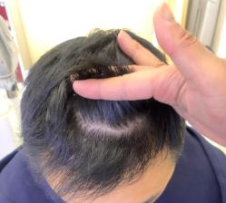 -大麦微针植发全国连锁